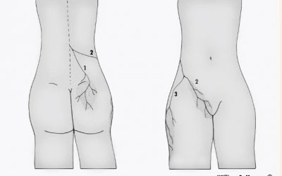 Tout savoir sur le Syndrome de Maigne : Comprendre et Traiter les Douleurs Lombaires